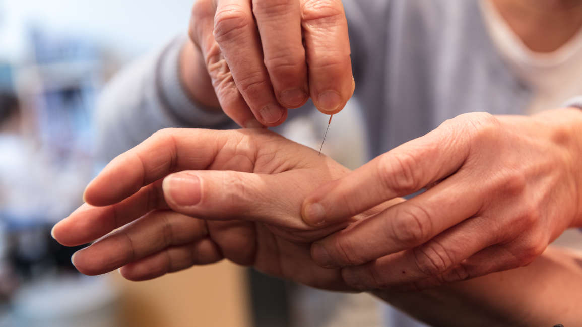 Akupunktur